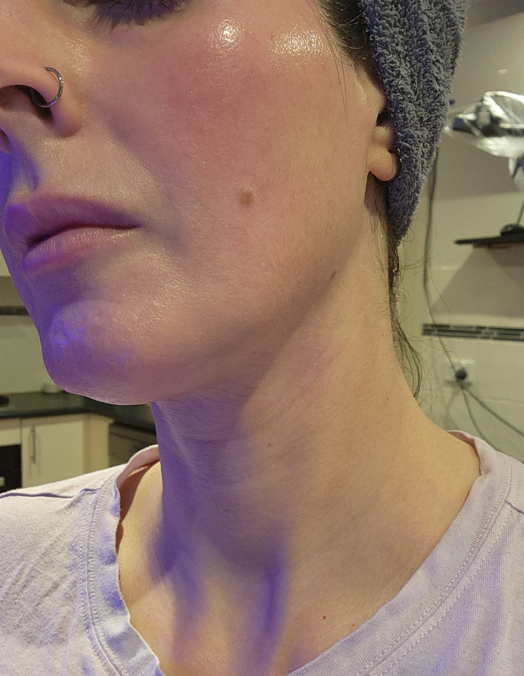 LED Face Mask For Rosacea