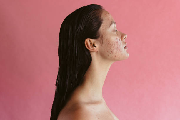 Best LED Light for Acne
