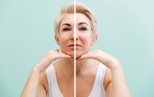 best at home light therapy for rosacea