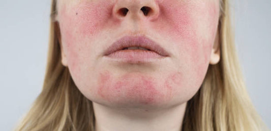 Can LED Light Therapy Help Rosacea