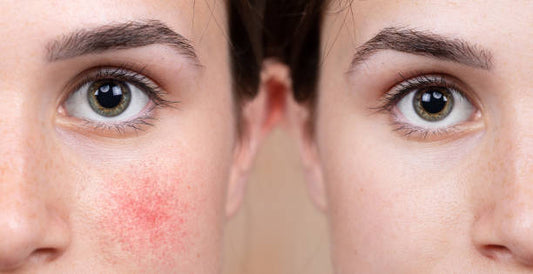 Does LED Light Therapy Help Rosacea