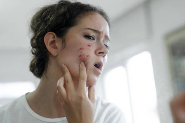 Does Red Light Therapy Help Acne