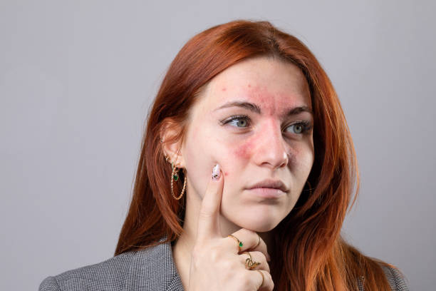 LED for Rosacea