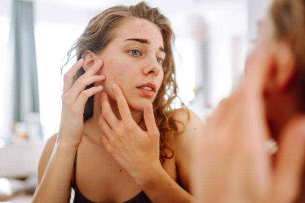 LED Light for Acne