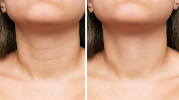 red light therapy for neck wrinkles australia