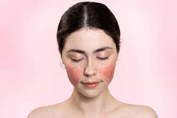 What Colour LED Mask Is Best for Rosacea