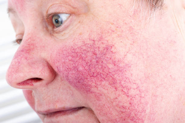 How Long to Use LED Face Mask for Rosacea