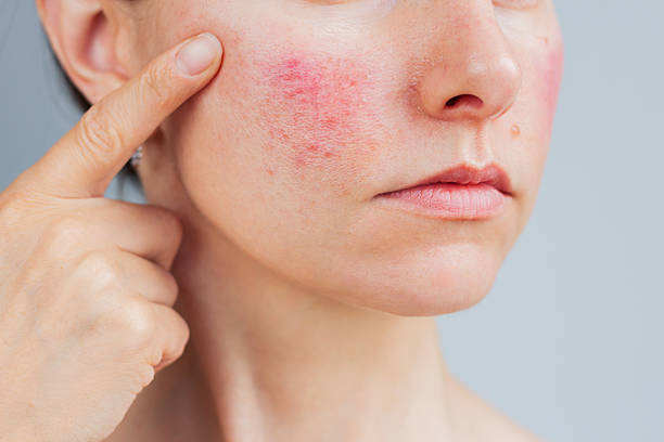 LED Therapy for Rosacea