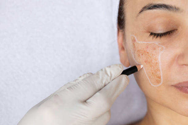 LED Mask for Pigmentation