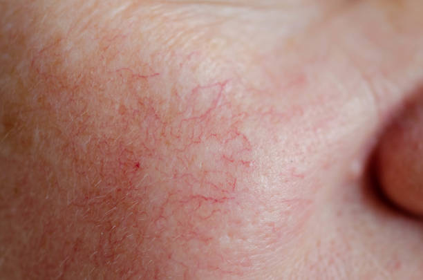 What Triggers Rosacea Flare Ups